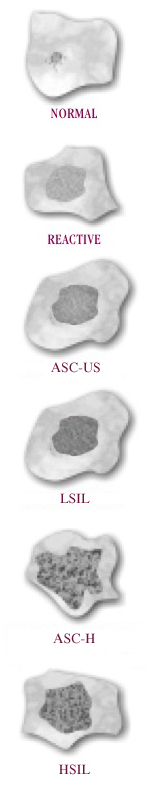 ASCUS ASCH